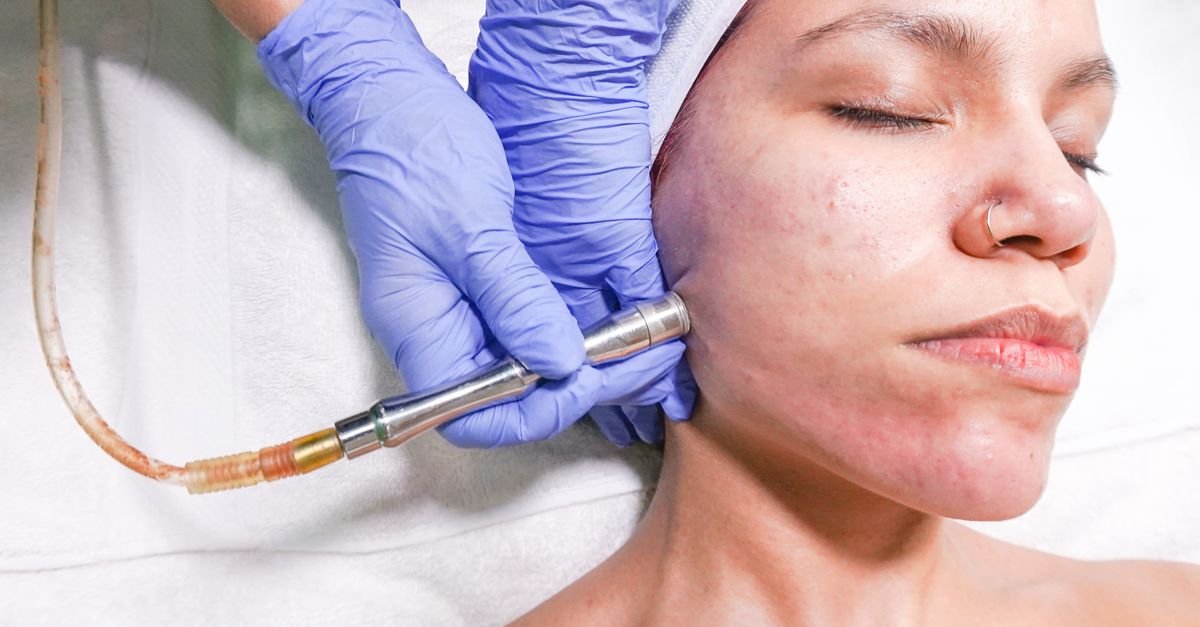 Praktisi melakukan perawatan mikrodermabrasi pada wajah wanita