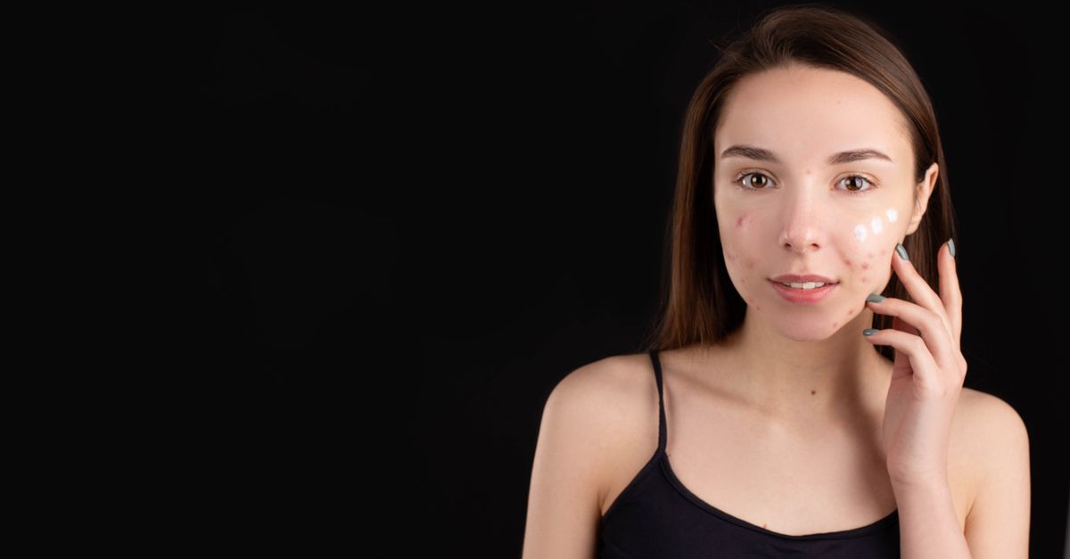 Makeup untuk Kulit Berjerawat: Cara Aman Tetap Coverage